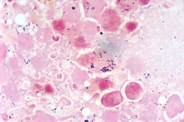 Tissue infected with bacterial kidney disease